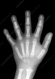 Ruth An Inspiration Swailes Fff On Twitter An X Ray Of A Developed Hand Around The Age Of 7 Compared To An Eyfs Age Child S Hand Is Pretty Informative Also Occupational Therapists