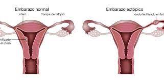 Dolor De Ovarios Sintoma De Embarazo Normal O De Embarazo Ectopico