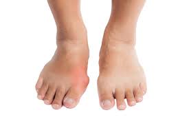 Jika wajah atau tangan terasa kering jangan abaikan kondisi kulit ini pada bagian telapak kaki anda. Bunion Gejala Penyebab Dan Mengobati Alodokter