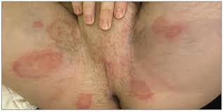 Sexually transmitted hard-to-treat Yeast or fungal infection - Dr Qaisar Ahmed