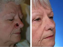 Everybody must know how to give the first aid. Repairing The Nose After Skin Cancer In Just One Step