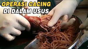 Cacingan pada manusia ini umumnya. Ngerinya Cacing Besar Ini Ditemukan Di Usus Manusia Hati Hati Yg Suka Ga Pakai Sandal Youtube