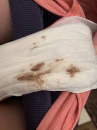 Only about a third of pregnant women experience implantation bleeding after they get pregnant, but it's considered a normal symptom of pregnancy. How Long Does The Bleeding Last While Pregnant