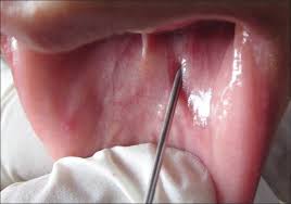 Image result for Pathergy