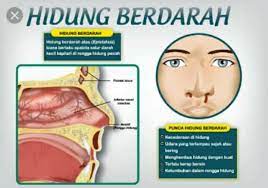 Sinus paranasal dan rongga nasal. Kanser Pangkal Hidung Cream Ajaib Bio Ever Plus Facebook