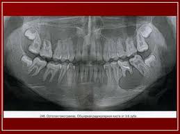 Image result for periostitis