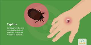 Yang disebut istilah tipus penyakit dalam adalah. Typhus Tanda Dan Gejala Penyebab Cara Mengobati Cara Mencegah
