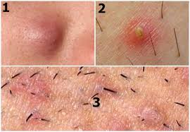 This is due to the embarrassment that adolescents associate it with. Ingrown Underarm Hair Treatment Prevention More