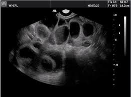 We did not find results for: Transvaginal Ultrasonography And Female Infertility Glowm