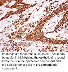 Mesothelioma can be categorized histologically as epithelioid type, sarcomatoid type, biphasic type, desmoplastic type, among others. Pathology Outlines Peritoneal Malignant Mesothelioma