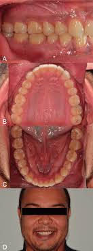 Right (A) sextant in occlusion. Occlusal views of the completed...