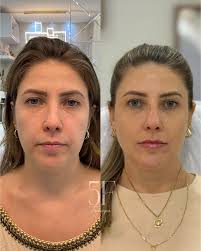 Franciely Follmann Boniatti| Harmonização Facial (@dra.franfollmann) •  Instagram फोटोहरू र भिडियोहरू