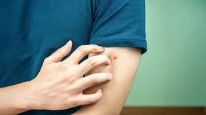 Image result for flea bites