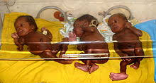 Multiple Birth Wikipedia