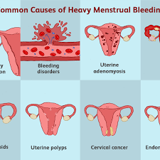 Heavy Menstrual Bleeding Menorrhagia Causes Symptoms Diagnosis