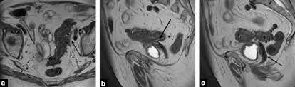 These small organs sit in a woman's pelvis and house the eggs that, when fertilized, become embryos that can develop into a as occurs in virtually every other part of the body, the ovaries can sometimes give rise to cancer. Digestive Diseases Mimicking Primary Gynecological Diseases Or With Secondary Gynecological Manifestations Sciencedirect