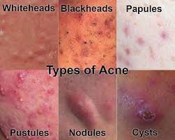 It doesn't seem like the kind of thing i would get a cortisone shot for, but i may be wrong. Cystic Acne Treatment Singapore Advice From A Doctors Perspective