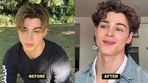 Pierre Boo Plastic Surgery. TikTokers Before-After Pictures.