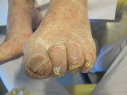 Image result for Onychogryphosis feet