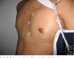 Poland syndrome is a rare condition that is evident at birth (congenital). Pdf Chest Wall Reconstruction In Male Poland Syndrome Semantic Scholar