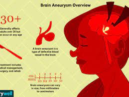 Brain Aneurysms: Symptoms, Causes, Diagnosis, And Treatment