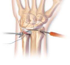 Von rumpere ,reißen') bezeichnet in der medizin die zerreißung oder den riss eines inneren organs, eines muskels, eines gefäßes, eines bandes oder einer sehne. Arthrex Arthroskopische Rekonstruktion Des Tfcc Mit Micro Suturelasso Inside Out Outside In