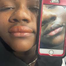 Neutralización de labios oscuros . Proceso de cicatrización de 40 días.  Para dar luego la sesión de color rosado o rojo . Costo 3 mil pesos la  sesión