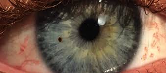 Image result for Eye Foreign Body