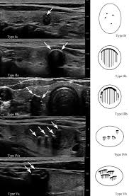 The abnormal cells begin multiplying in your thyroid and, once there are enough of them, they form a tumor. Relationship Between Morphologic Characteristics Of Ultrasonic Calcification In Thyroid Nodules And Thyroid Carcinoma Ultrasound In Medicine And Biology