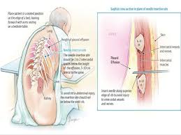 Https Image Slidesharecdn Com Thoracentesisfinal 150414095646 Conversion Gate01 95 Thoracentesis Pleural Effusion Medical School Essentials Medical Knowledge