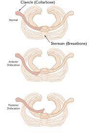 A clavicle bone lump can be caused by a variety of conditions. Sternoclavicular Sc Joint Disorders Orthoinfo Aaos