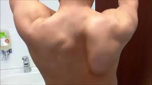 Image result for Winged Scapula