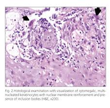 Cmv esophagitis usually affects immunosuppressed or immunodeficient people. Esofagitis Herpetica Presentacion En Adolescente Inmunocompetente