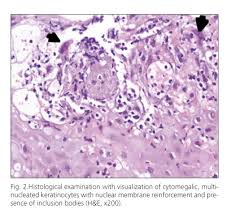 Esophagitis can occur from irritation from toxic or abrasive materials ingested or from gastric reflux. Esofagitis Herpetica Presentacion En Adolescente Inmunocompetente