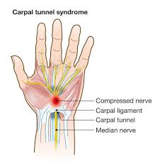 What Causes Carpal Tunnel Syndrome Catching Health With Diane Atwoo