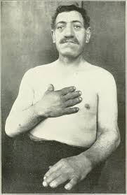 Image result for Acromegaly