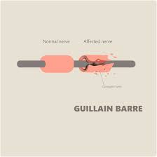 Most often, gbs presents as an acute, monophasic paralyzing illness provoked by a preceding infection. Guillain Barre Syndrome Treatment