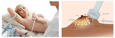Breast biopsy | Ultrasound | Breast Cancer Specialist Dubai