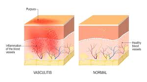 Image result for Vasculitis