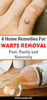 8 Home Remedies For Warts Removal Fast Easily And Naturally Home Remedies For Warts Warts Remedy Remedies