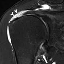 Image result for Shoulder MRI