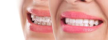 Traditional metal braces typically cost between $3,000 and $7,000. Clear Braces Vs Metal Braces Wild Smiles