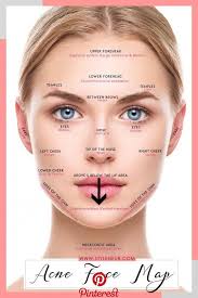 Get Rid Of Cheek Acne Acne And Pimples Appear In Some Other Part Of Your Body Such As The Cheeks Skin Problem A Acne Face Chart Acne On Nose Face Mapping