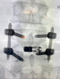 Cirurgia_coluna - Araújo e Fazzito - Neurocirurgia e Neurologia em São  Paulo | Araújo e Fazzito - Neurocirurgia e Neurologia em São Paulo