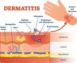 Ekzem ist ein sammelbegriff für entzündliche veränderungen der haut, der eine gruppe sehr heterogener dermatologischer erkrankungen zusammenfasst. Mit Marly Skin Frei Von Ekzemen Und Hautirritationen Werden