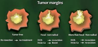 Margins help show whether or not all of the tumor was removed. The Radiology Assistant Staging And Treatment Of Breast Cancer