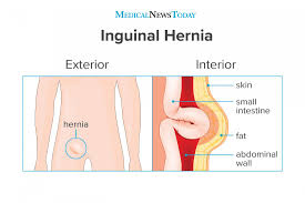 Image result for Inguinal hernia man