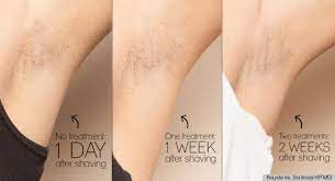 The average cost of laser hair removal is $429, according to the american society of plastic surgeons. Laser Hair Removal For Underarms Cost In Dubai Abu Dhabi Price