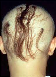 Vitiligo in individuals with darker skin is more noticeable; Nonbullous Skin Diseases Alopecia Areata Vitiligo Psoriasis And Urticaria Sciencedirect