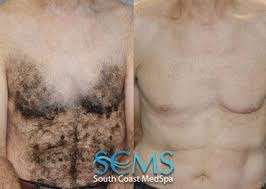 At romeo & juliette laser hair removal, we offer the widest assortment of lasers and the newest technology so that we can successfully remove hair for our male who are the ideal candidates for male laser hair removal? Pin On Laser Hair Removal Before And Afters